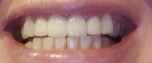 My beautiful teeth! Almost 3 years I walked into Dr. Nina Sonin and over a year since I have had a cleaning.