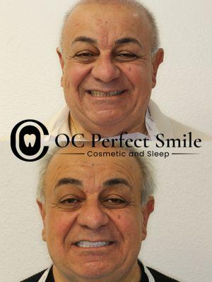 Full Mouth Reconstruction By Dr. H of the best cosmetic dentist in Orange County, CA. $500 Off Dental Implants, Call (949) 810-0121