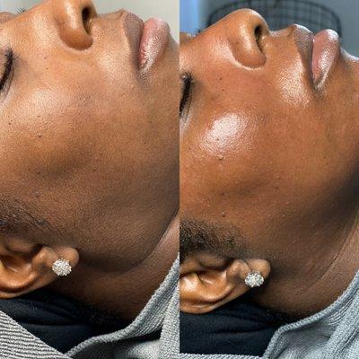 Dermaplaning before and after