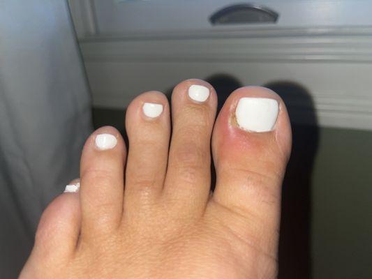 Infected toenail