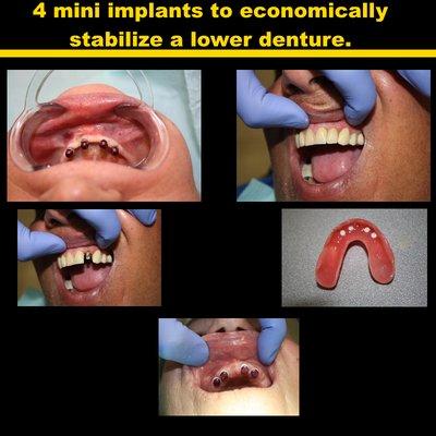 4 Mini Implants to Economically Stabilize A Lower Denture