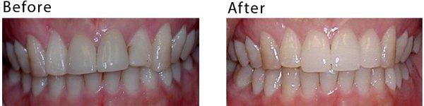 Gingival tissue and upper 4 front teeth were adjusted esthetically. Front 4 teeth were restored with Ceramic crowns (Cerec).