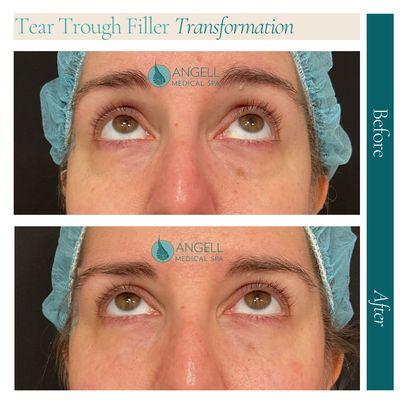 Under eye Tear trough filler