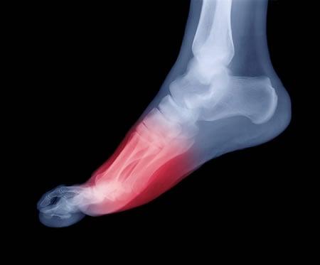 Foot Pain?  We can help!   We have K-Laser!  Call to find out more!