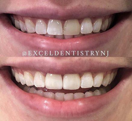 Before & After: Veneers