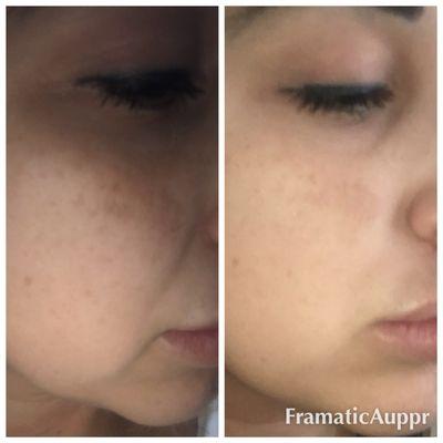 Dermal infusion before and after for sun damage on the upper cheeks.