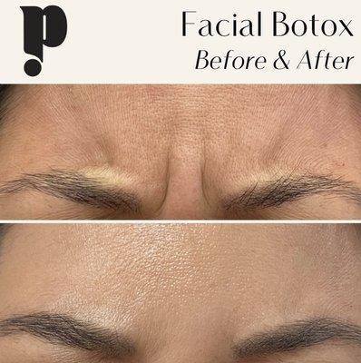 Botox Results by Pamela