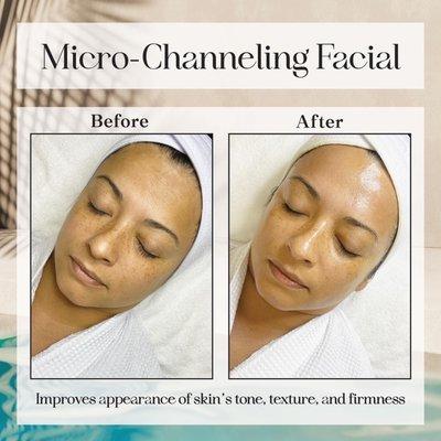 Micro channeling facial