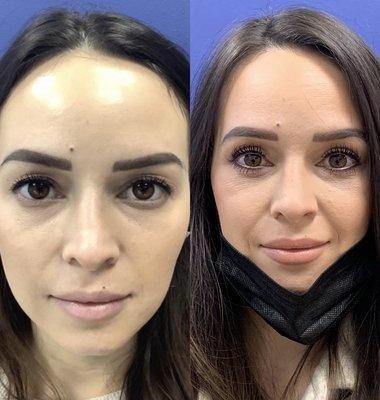 After in-office Upper Eyelid Blepharoplasty by Dr. Iyengar