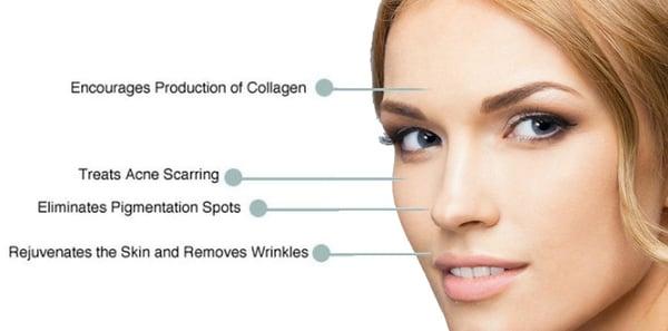 The benefits of microneedling