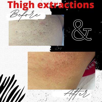 Inner thigh extractions