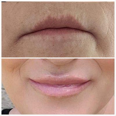 We love it when clients share after pictures. 1 week after lip filler.   Call to book your appointment 425-347-9999