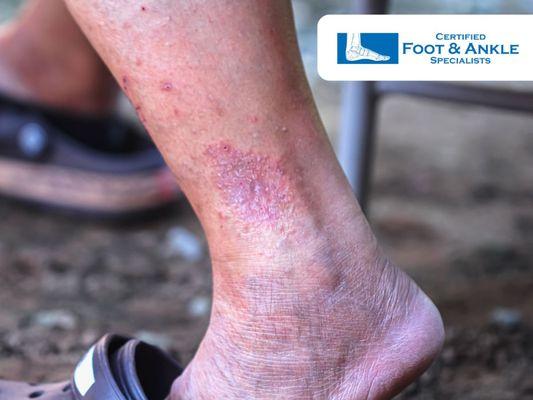 Ankle Rash Causes and Treatment