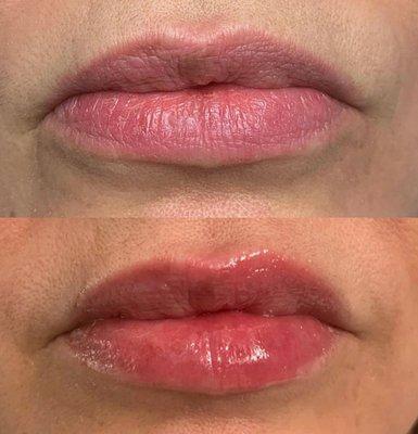 Hyapen Lip Treatment