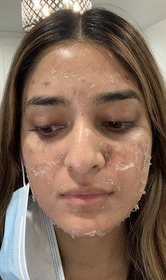 Advanced peel to target and diminish acne scarring and pitting