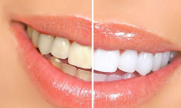 Professional ZOOM Whitening in 45 minutes