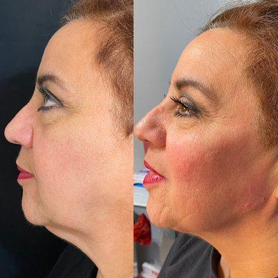 Full face correction