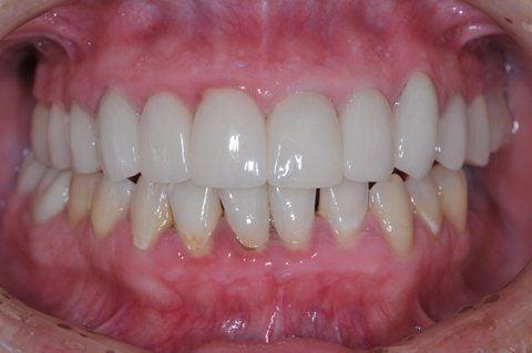 After#1- Full Maxillary arch restoration