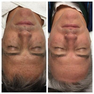 Before & After: Perfect Peel