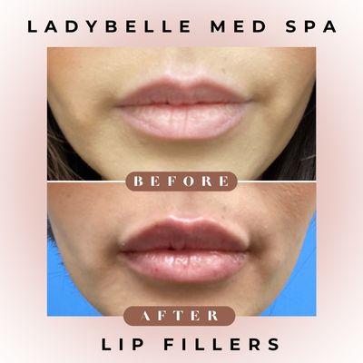 Lip filler to hydrate, define and enhance