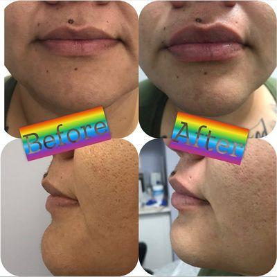 Hyaluronic acid lip fillers 1Ml