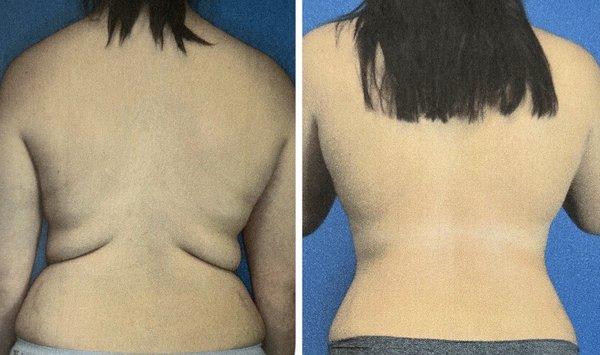 Bra rolls, waist, hips. Before and after liposuction