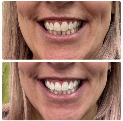 Teeth whitening up to 15 shades lighter