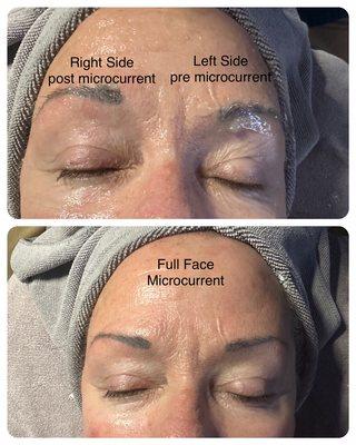 Myolift Facial - alternative to face lift surgery!