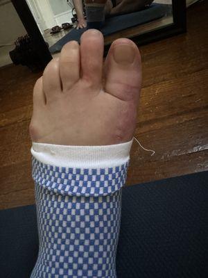 my foot after the wrong surgery