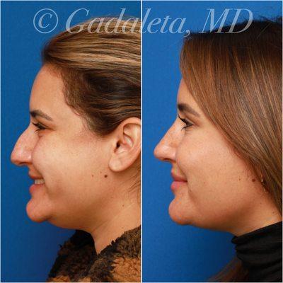 Before & After: Rhinoplasty and submental liposuction