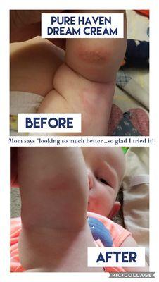 Clear irritations on your babies delicate skin