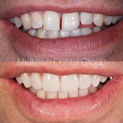 Can I close a gap between my front teeth with two veneers? Yes, you can! We offer complimentary cosmetic consultations!