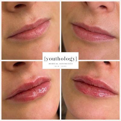 Natural Lip filler results!