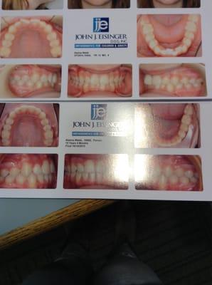 Before and after of my teeth