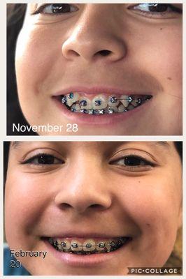 My daughter got her braces on November 28 the results are amazing! Very satisfied with Dr Rondon and his team!