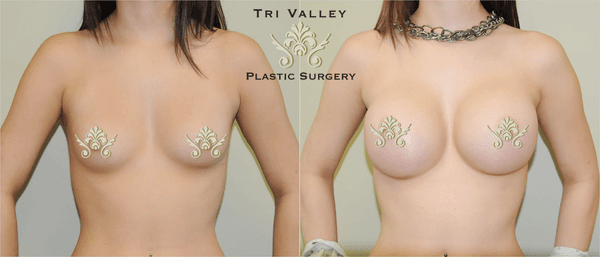 Silicone breast augmentation before and after by Dr. Williams