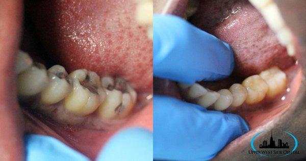 Replace metal fillings Before and After