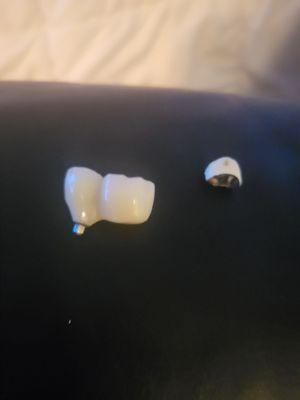 THE IMPLANTS AND THE TEETH NEXT TO IT...HOW CAN LAUGH TODAY IF I CANT SMILE TOMORROW..