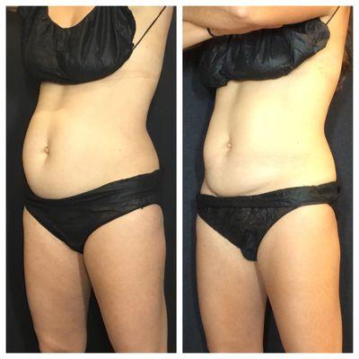 Treat unwanted belly fat with CoolSculpting at Metro Laser!