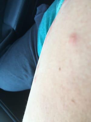 Bites on my arm