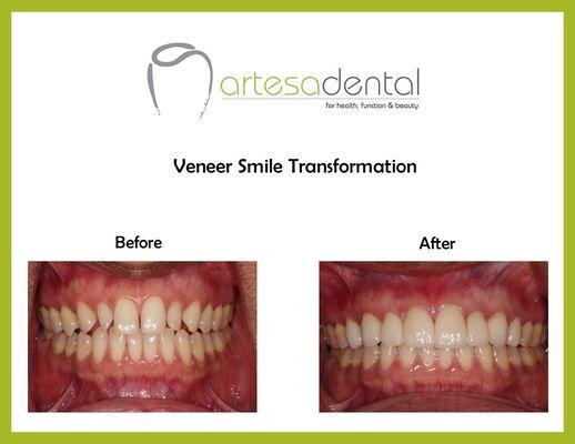 Veneers can completely change your smile.