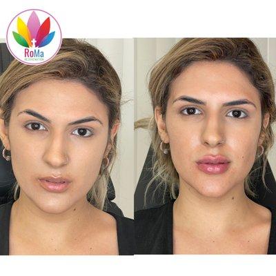 Lip Filler and Botox treatments in Riverside California