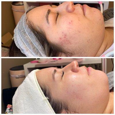 chemical peel series!