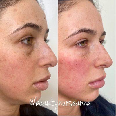 Before and After cheek and under eye filler