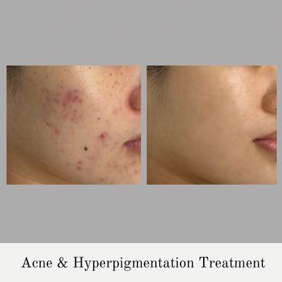 Acne & Hyperpigmentation Treatment