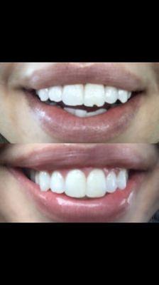 Before and After Dr. Cantrell helped fix my chipped tooth!