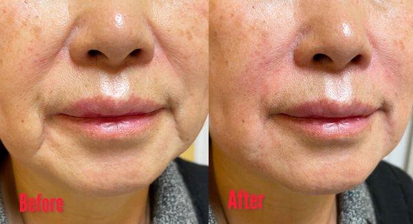 Lower face rejuvenation