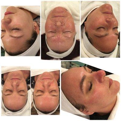 Facials By Brittany here at studio 841 I offer The Hydrafacial, Chemical Peels, Microdermabrasion, Facial massaged, waxing and more.