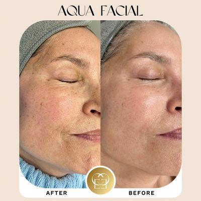 Aqua Facial before and after