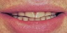 Worn Teeth Before